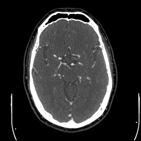 File:Acute A3 occlusion with ACA ischemic penumbra (CT perfusion) (Radiopaedia 72036-82527 Axial C+ arterial phase thins 90).jpg