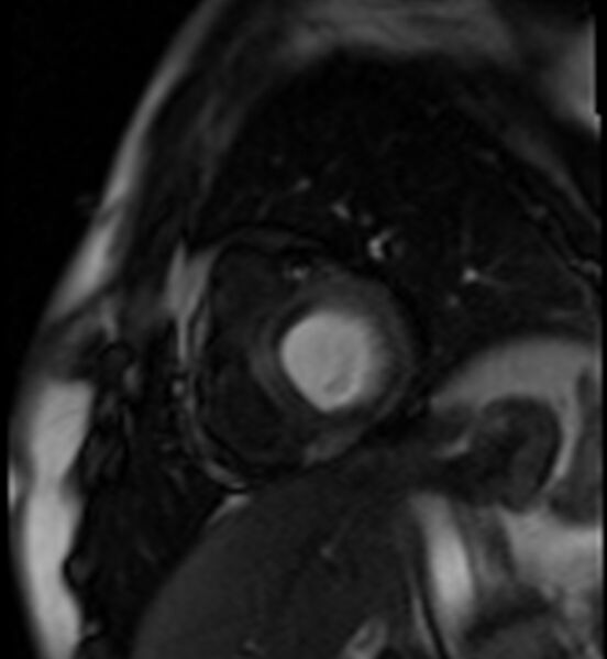 File:Acute anteroseptal myocardial infarction (Radiopaedia 68409-77945 Short axis (basal) Perfusion 12).jpg