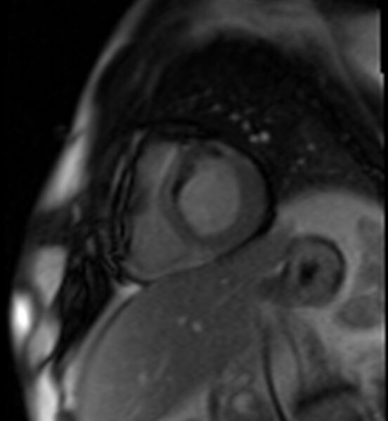 File:Acute anteroseptal myocardial infarction (Radiopaedia 68409-77945 Short axis (basal) Perfusion 30).jpg
