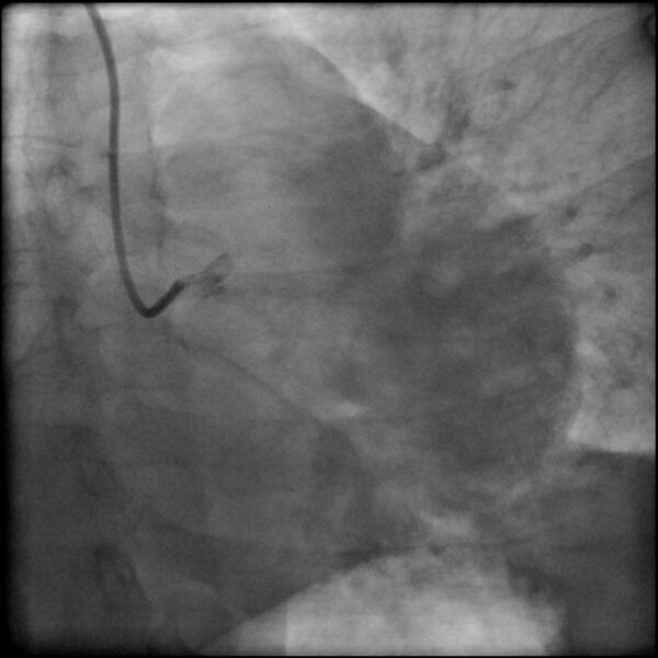 File:Acute anteroseptal myocardial infarction (Radiopaedia 68409-77946 LAO caudal (spider view) LAD and CX 12).jpg