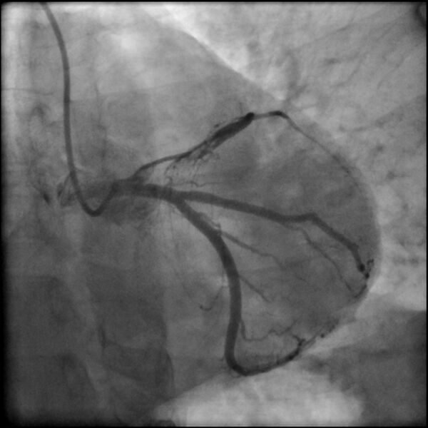 File:Acute anteroseptal myocardial infarction (Radiopaedia 68409-77946 LAO caudal (spider view) LAD and CX 34).jpg
