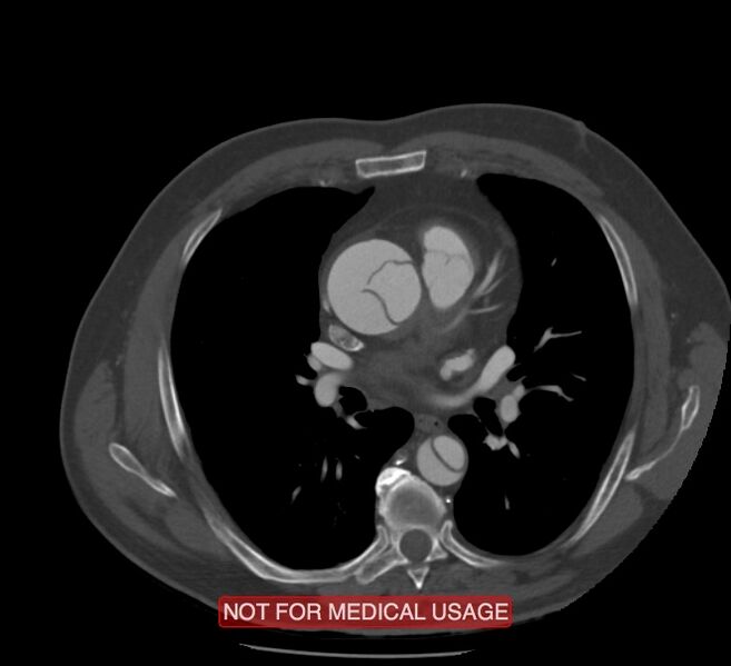 File:Acute aortic dissection - Stanford type A (Radiopaedia 40661-43285 Axial C+ arterial phase 30).jpg