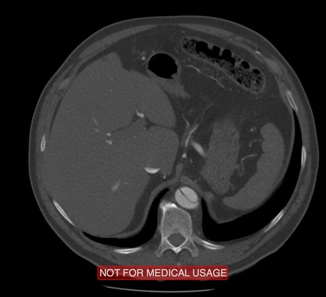 File:Acute aortic dissection - Stanford type A (Radiopaedia 40661-43285 Axial C+ arterial phase 77).jpg