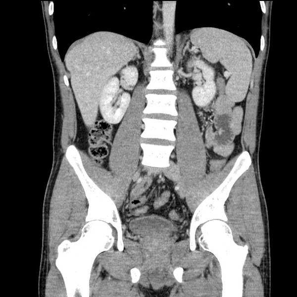 File:Acute appendicitis (Radiopaedia 27049-27227 Coronal C+ portal venous phase 33).jpg