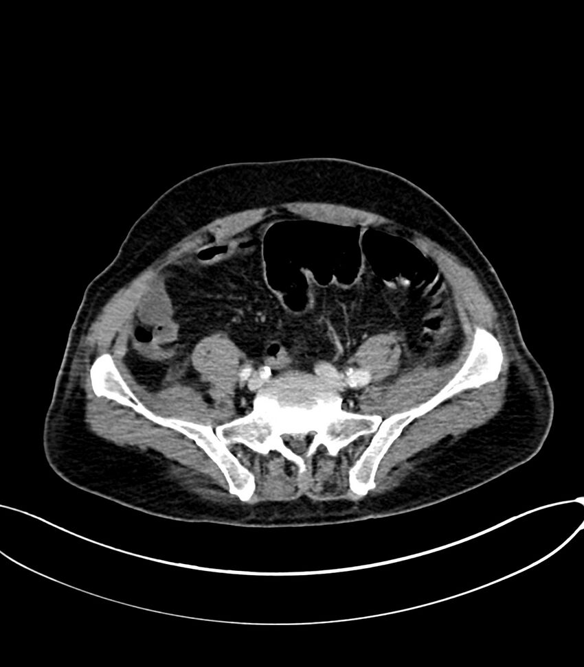 Acute arterial mesenteric ischemia (Radiopaedia 78238-90828 Axial C+ portal venous phase 104).jpg