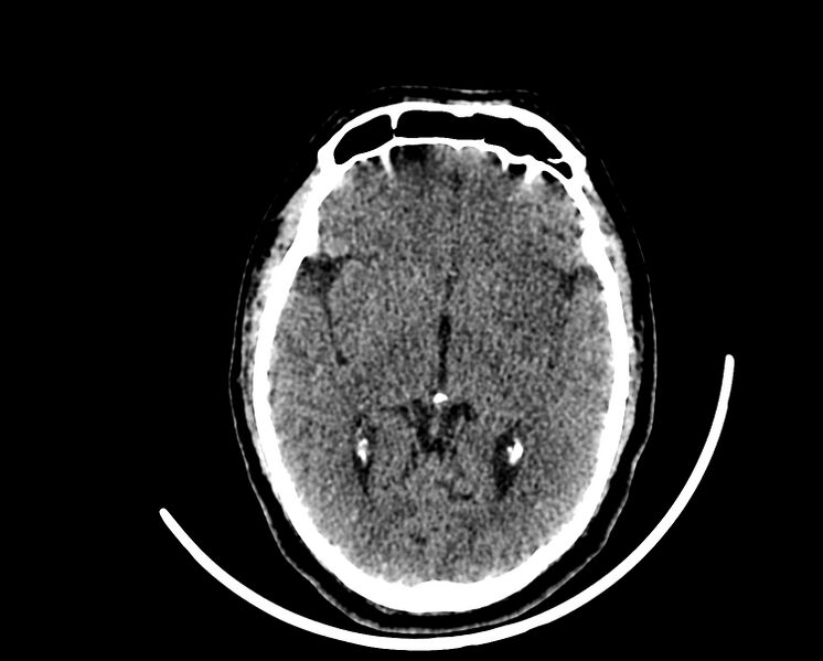 File:Acute cerebral infarct (Radiopaedia 35604-37123 Axial non-contrast 48).jpg