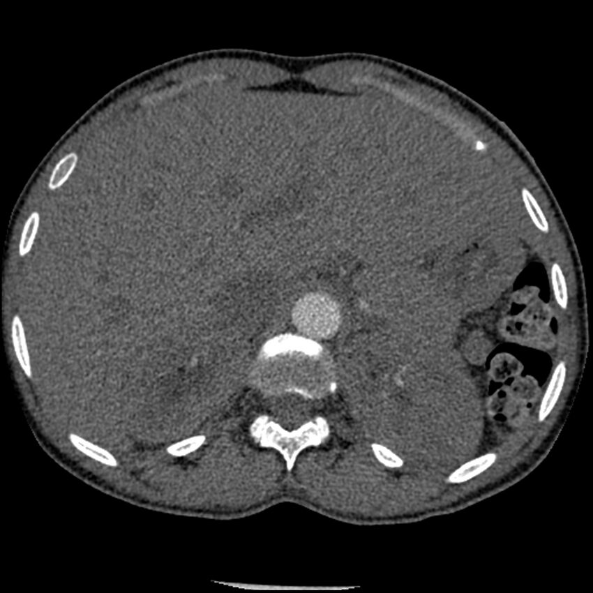 Acute chest syndrome - sickle cell disease (Radiopaedia 42375-45499 Axial C+ CTPA 198).jpg