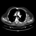 Acute heart failure (CT) (Radiopaedia 79835-93075 Axial C+ arterial phase 4).jpg