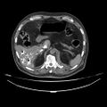 Acute heart failure (CT) (Radiopaedia 79835-93075 Axial C+ arterial phase 89).jpg