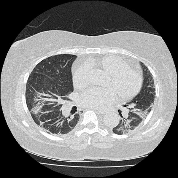 File:Acute interstitial pneumonitis (Radiopaedia 45404-49452 Axial lung window 53).jpg