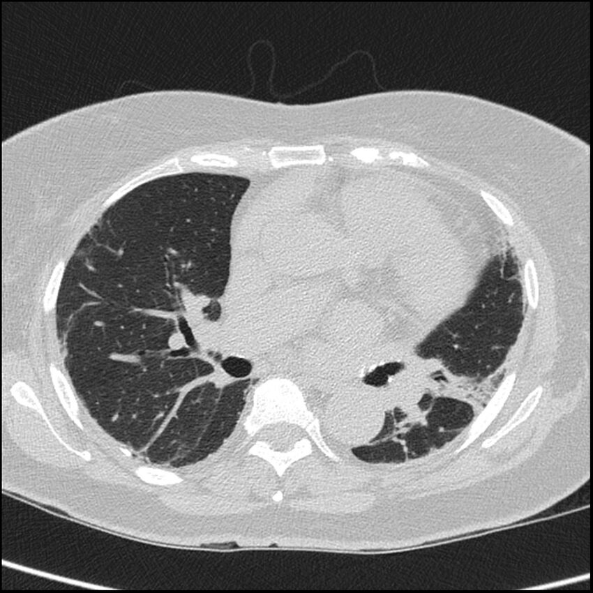 Acute interstitial pneumonitis (Radiopaedia 45404-49453 Axial lung window 42).jpg