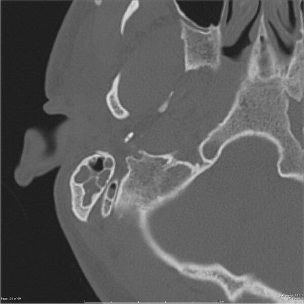 File:Acute otomastoiditis (Radiopaedia 28276-28512 Axial PTB bone window reformat 65).jpg