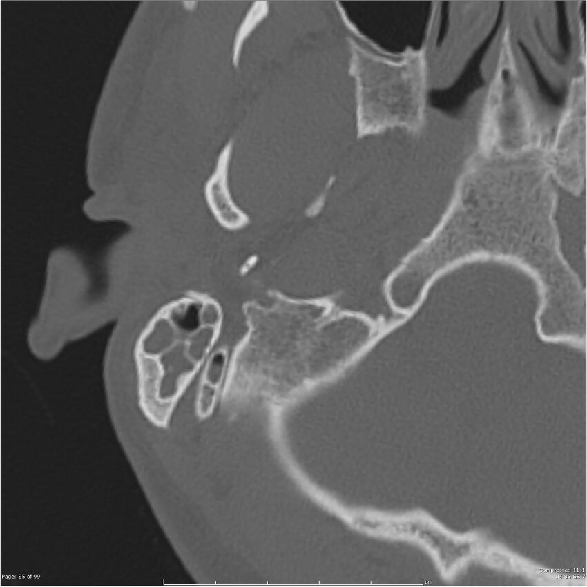 Acute otomastoiditis (Radiopaedia 28276-28512 Axial PTB bone window reformat 65).jpg