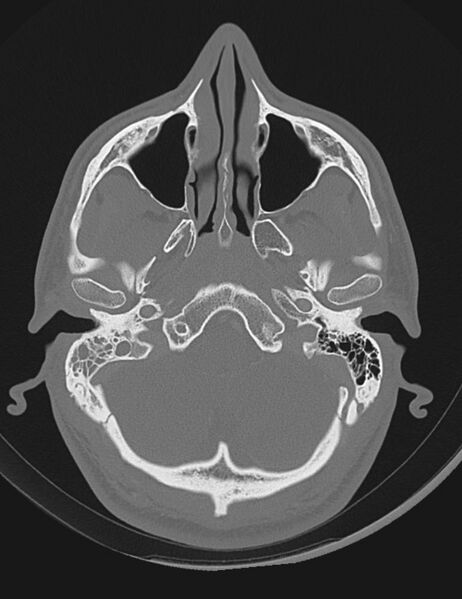 File:Acute otomastoiditis (Radiopaedia 28329-28575 Axial bone window 1).jpg