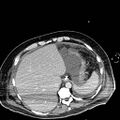 Acute pancreatic necrosis (Radiopaedia 13560-18501 Axial C+ portal venous phase 19).jpg