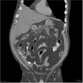 Acute pancreatitis (Radiopaedia 19135-19116 Coronal non-contrast 11).jpg