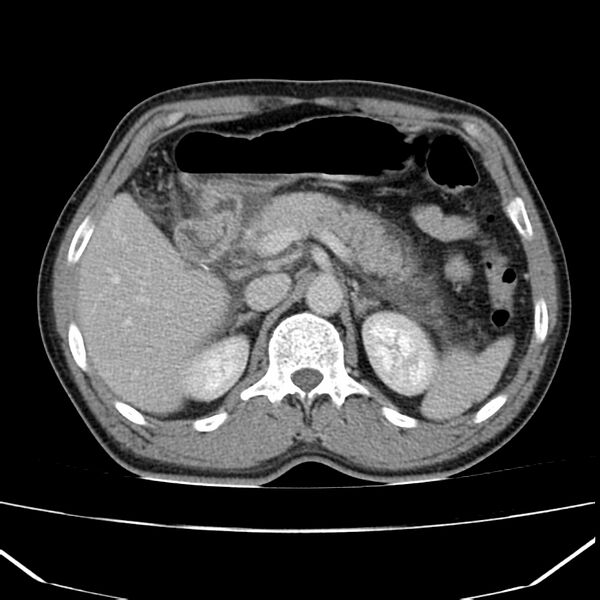 File:Acute pancreatitis (Radiopaedia 22572-22596 Axial C+ portal venous phase 23).jpg