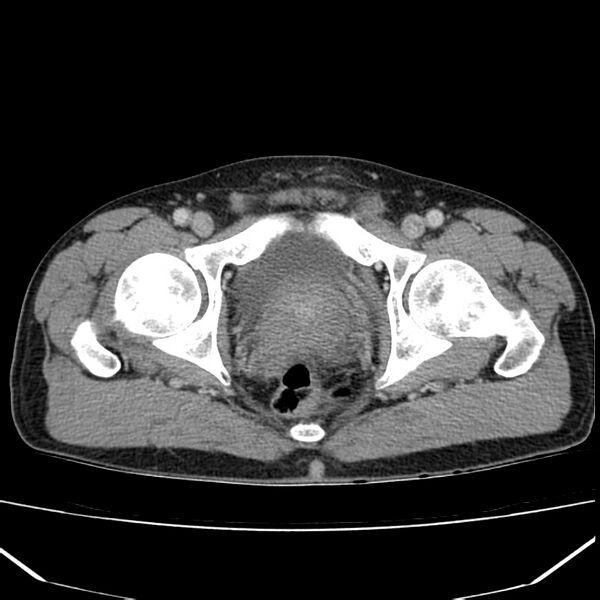 File:Acute pancreatitis (Radiopaedia 22572-22596 Axial C+ portal venous phase 71).jpg