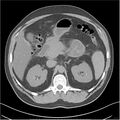 Acute pancreatitis - mild (Radiopaedia 27796-28033 Axial non-contrast 11).jpg
