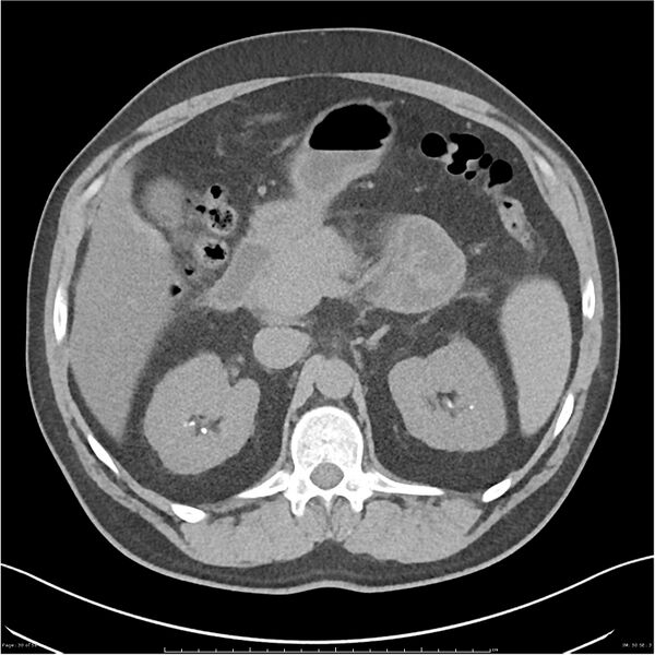 File:Acute pancreatitis - mild (Radiopaedia 27796-28033 Axial non-contrast 11).jpg