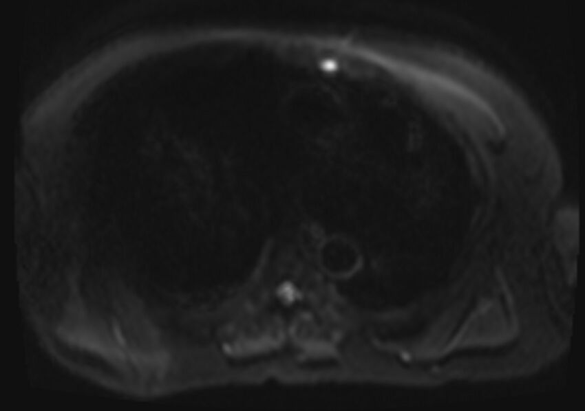 Acute portal vein thrombosis (Radiopaedia 73198-83925 Axial DWI 2).jpg