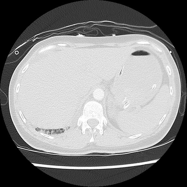 File:Acute pulmonary edema on CT (Radiopaedia 33582-34672 Axial lung window 52).jpg
