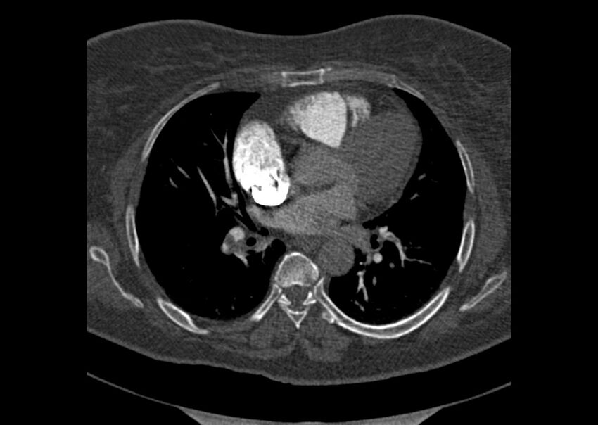 Acute pulmonary embolism (Radiopaedia 29938-30466 Axial C+ CTPA 105).jpg
