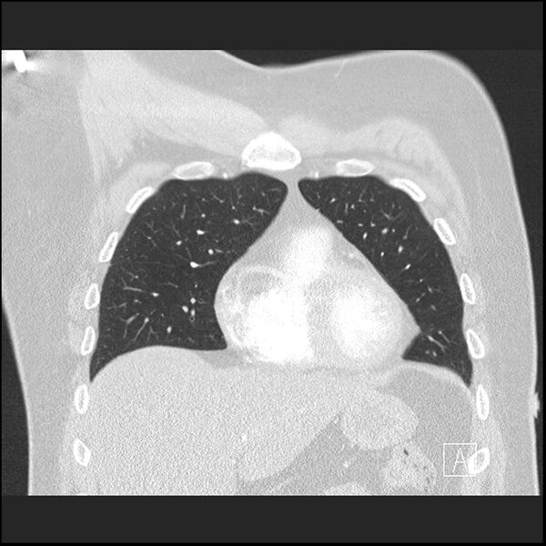 File:Acute pulmonary embolism with pulmonary infarct (Radiopaedia 73062-83768 Coronal lung window 21).jpg