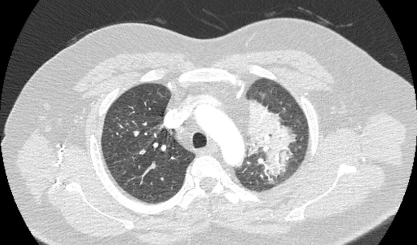 Acute pulmonary embolism with pulmonary infarcts (Radiopaedia 77688-89908 Axial lung window 21).jpg