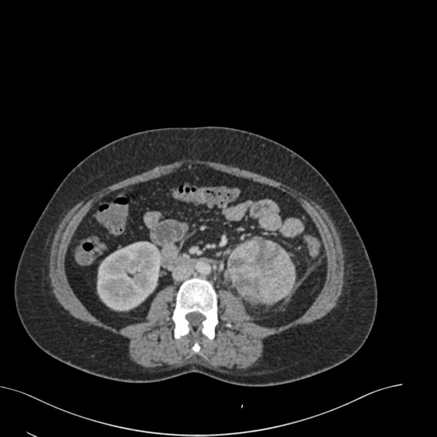 Acute pyelonephritis with renal vein thrombosis (Radiopaedia 58020-65053 Axial renal parenchymal phase 99).jpg
