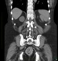 Acute renal failure post IV contrast injection- CT findings (Radiopaedia 47815-52557 Coronal non-contrast 38).jpg