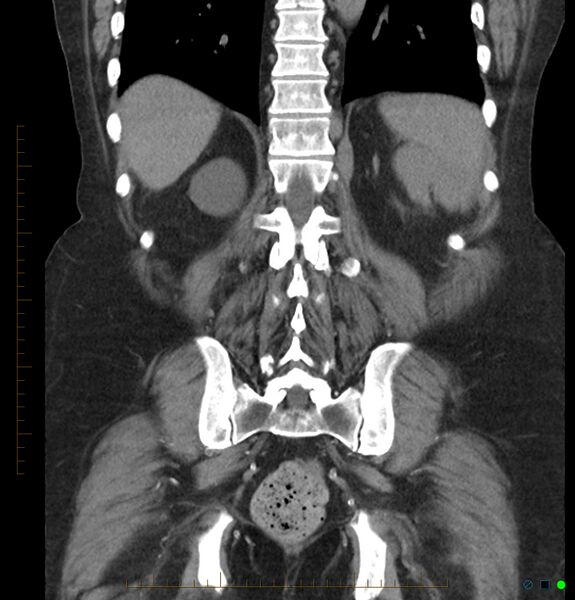 File:Acute renal failure post IV contrast injection- CT findings (Radiopaedia 47815-52557 Coronal non-contrast 38).jpg