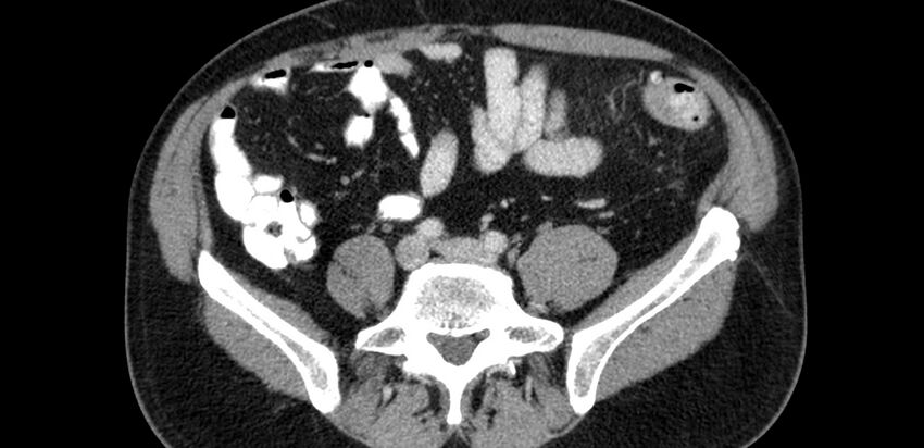 Acute sigmoid colon diverticulitis (Radiopaedia 55507-61976 Axial C+ portal venous phase 57).jpg