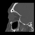 Acute sinusitis (Radiopaedia 23161-23215 Sagittal bone window 47).jpg