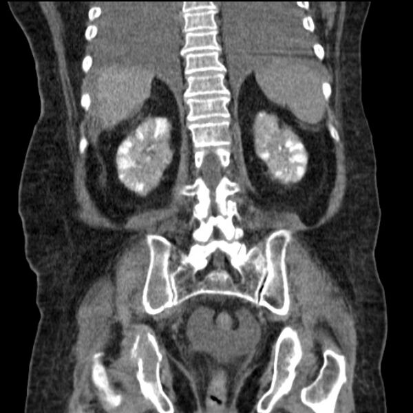 File:Acute tubular necrosis (Radiopaedia 28077-28334 D 62).jpg