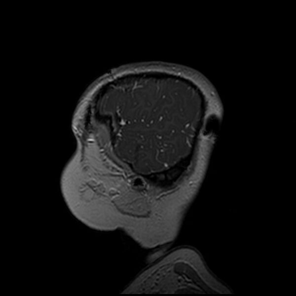File:Adamantinomatous craniopharyngioma (Radiopaedia 77407-89529 H 109).jpg