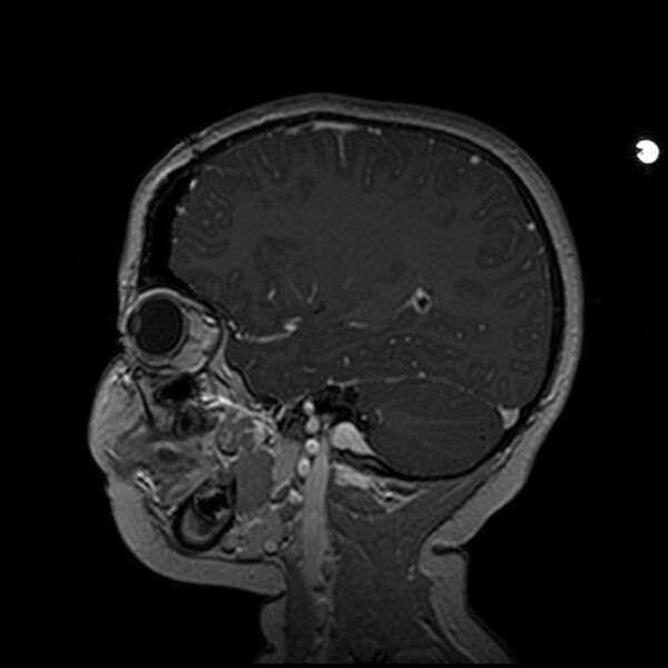 File:Adamantinomatous craniopharyngioma (Radiopaedia 77407-89529 H 39).jpg
