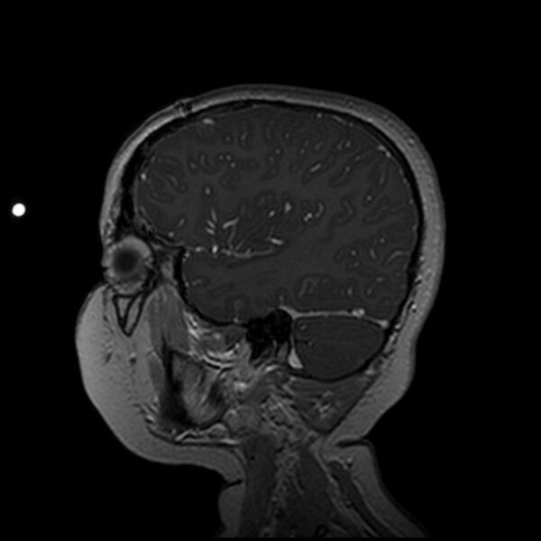 File:Adamantinomatous craniopharyngioma (Radiopaedia 77407-89529 H 93).jpg