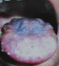 Hyperpigmentation and depapillation of the tongue