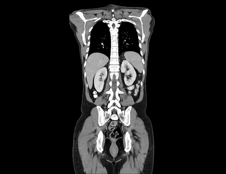 File:Addison disease (Radiopaedia 49318-54412 Coronal C+ portal venous phase 11).jpg