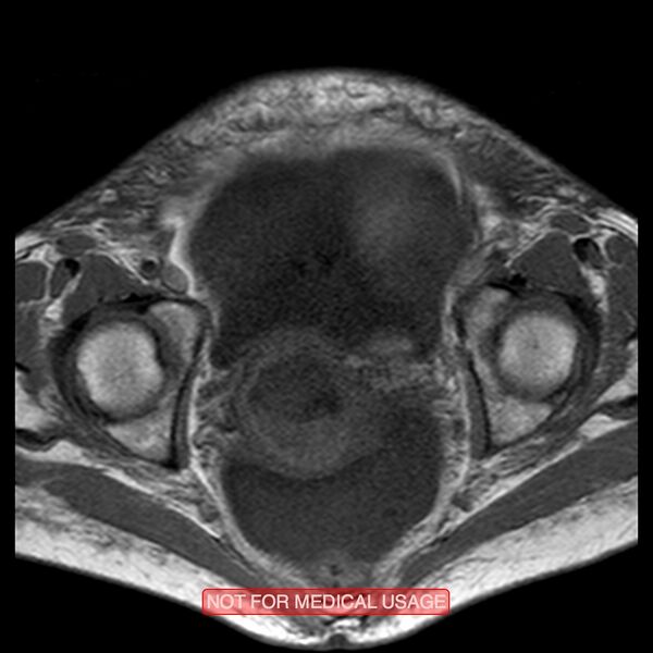 File:Adenocarcinoma of the cervix (Radiopaedia 28373-28615 Axial T1 10).jpg