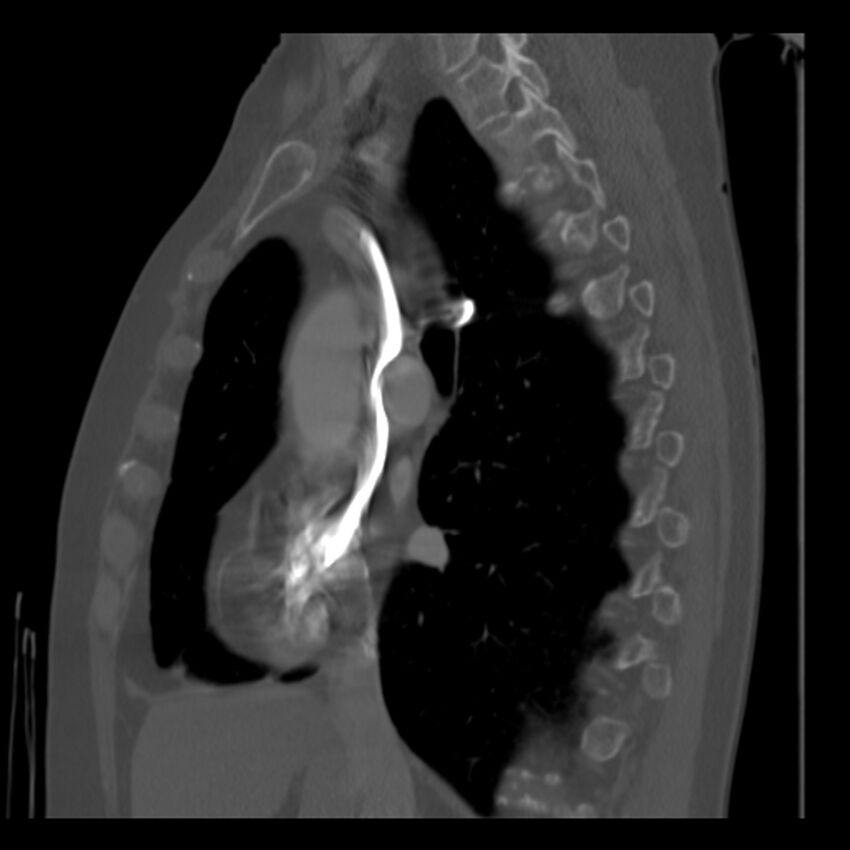 Adenocarcinoma of the lung (Radiopaedia 41015-43755 Sagittal bone window 46).jpg