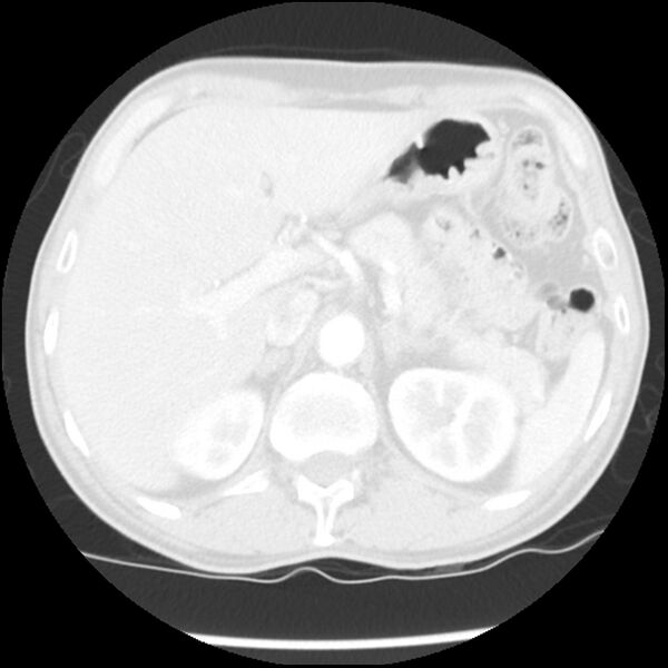 File:Adenocarcinoma of the lung - micropapillary predominant (Radiopaedia 42446-45563 Axial lung window 74).jpg