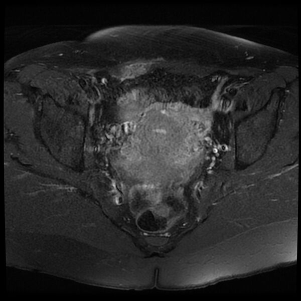 File:Adenomyosis-scar endometriosis (Radiopaedia 65863-75022 Axial T1 C+ fat sat 14).jpg