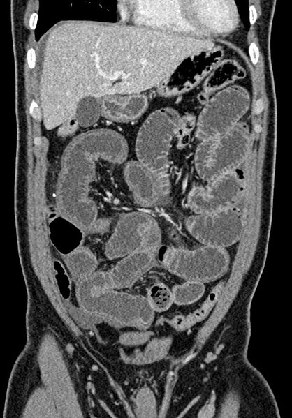 File:Adhesional small bowel obstruction (Radiopaedia 58900-66131 Coronal C+ portal venous phase 99).jpg