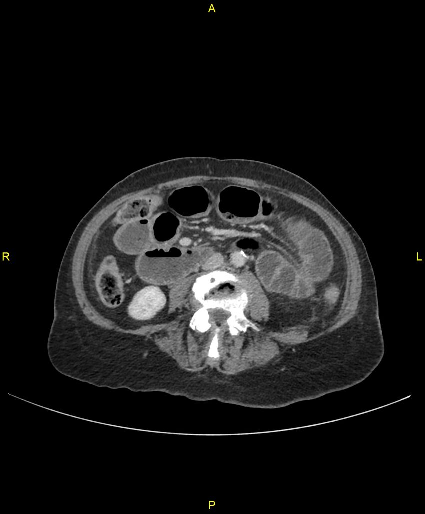 Adhesional small bowel obstruction (Radiopaedia 85402-101024 Axial C+ portal venous phase 152).jpg