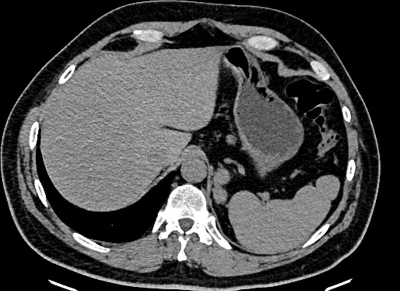 File:Adrenal metastases (Radiopaedia 73082-83791 Axial non-contrast 32).jpg