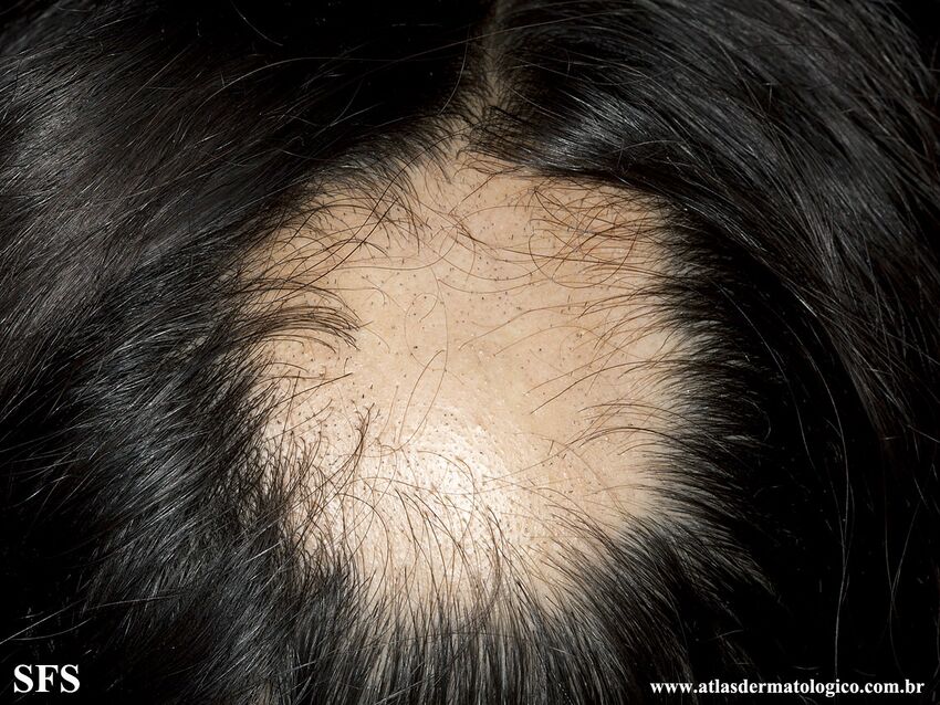 Alopecia Areata (Dermatology Atlas 68).jpg