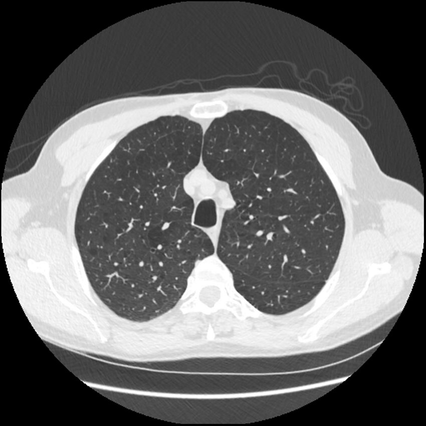 Alpha-1-antitrypsin deficiency (Radiopaedia 40993-43722 Axial lung window 52).jpg