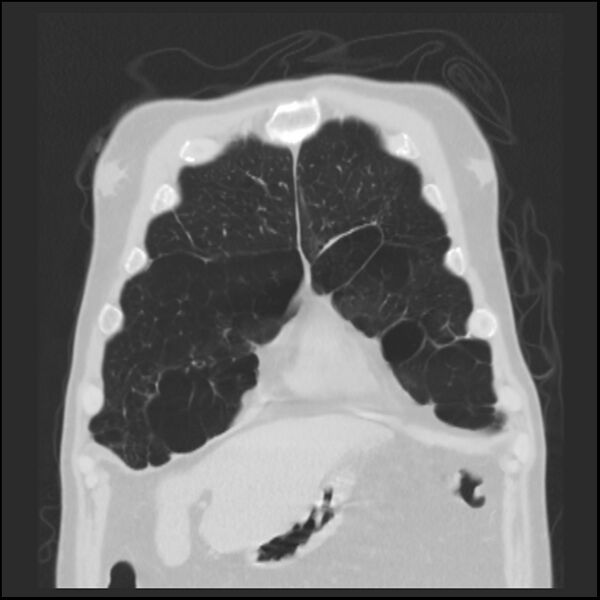 File:Alpha-1-antitrypsin deficiency (Radiopaedia 40993-43722 Coronal lung window 14).jpg